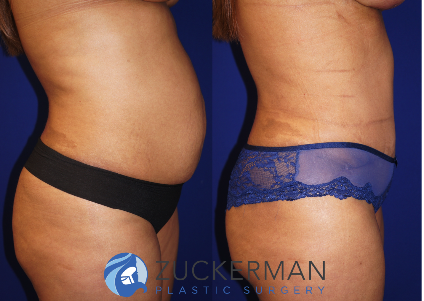 Right profile view of an abdominoplasty (tummy tuck) by Dr. Zuckerman, images taken before surgery and two months after. Includes liposuction to the abdomen and flanks.