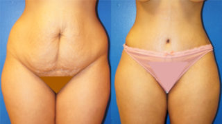 Tummy Tuck Procedure: What Are The Different Types? - Dr. Markarian