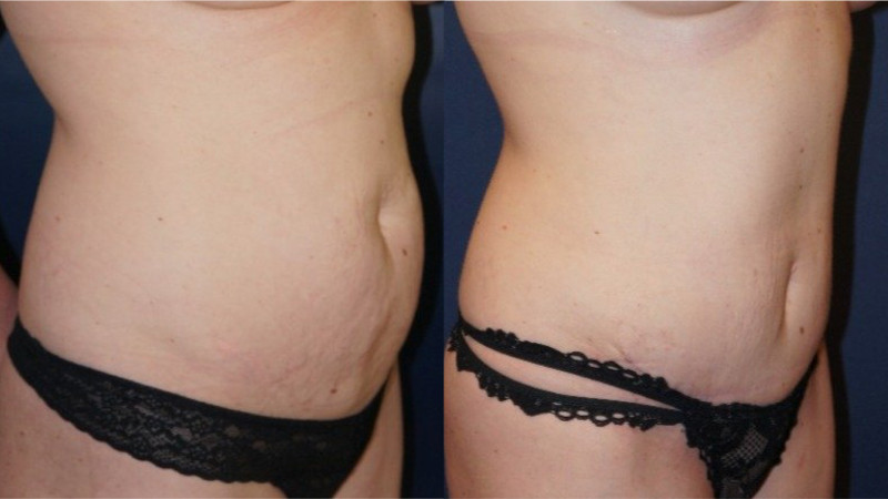 Right oblique view of a mini tummy tuck outcome by Dr. Zuckerman.