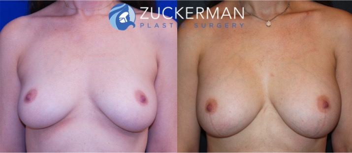 breast augmentation patient, female, joshua zuckerman, 3 months after. 350cc Mentor Round silicone implants placed submuscular, frontal view