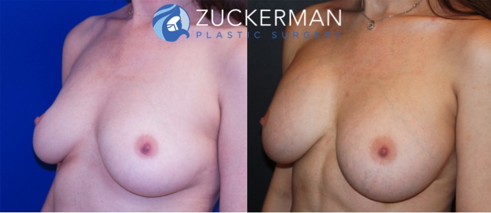 breast augmentation patient, female, joshua zuckerman, 3 months after. 350cc Mentor Round silicone implants placed submuscular, left oblique view