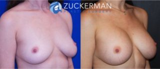 Right oblique view, breast augmentation patient, female. Before and 3 months after. 350cc Mentor Round silicone implants placed submuscular.