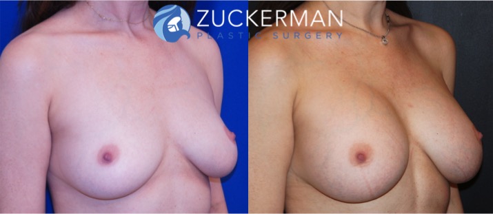 breast augmentation patient, female, joshua zuckerman, 3 months after. 350cc Mentor Round silicone implants placed submuscular, right oblique view