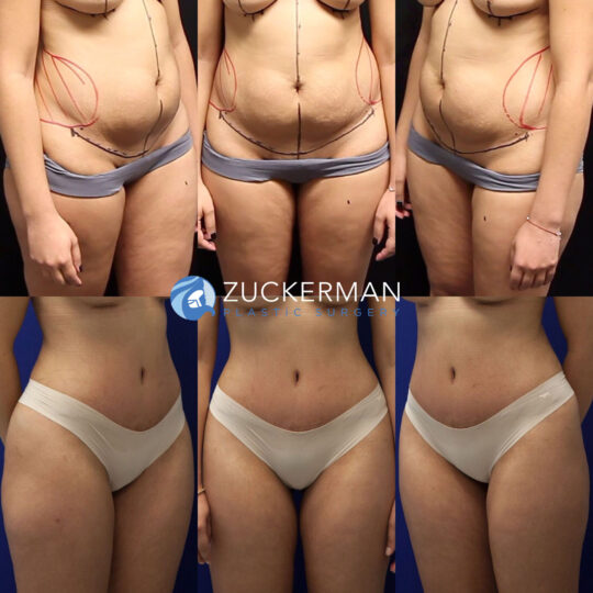 tummy tuck, abdominoplasty, before and after