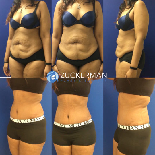 tummy tuck, abdominoplasty, before and after