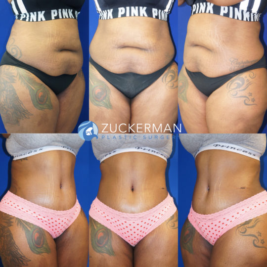 tummy tuck, abdominoplasty, bbl, brazilian butt lift, before and after