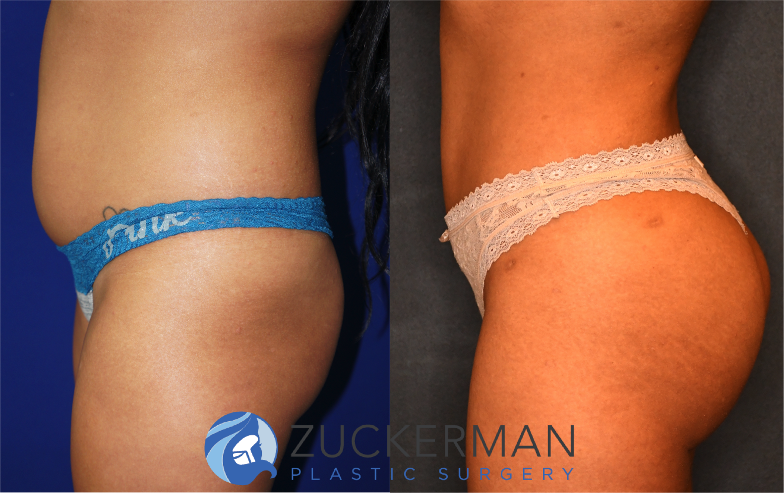 brazilian butt lift, bbl, buttock augmentation, 5, before and after, joshua zuckerman, left profile view