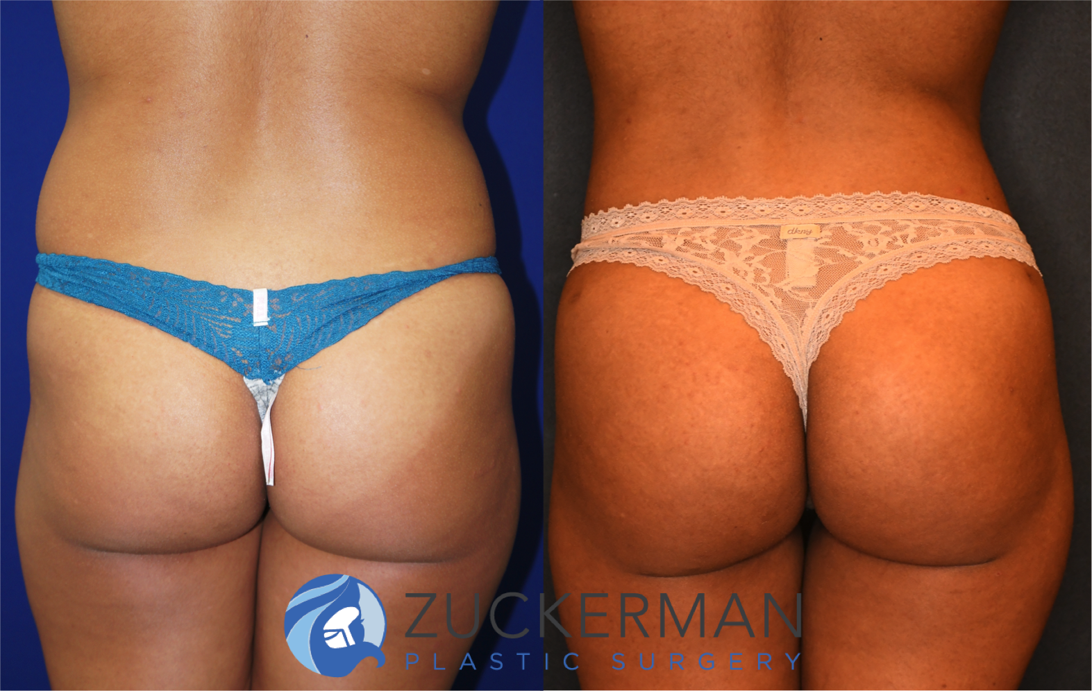 brazilian butt lift, bbl, buttock augmentation, 5, before and after, joshua zuckerman, posterior view