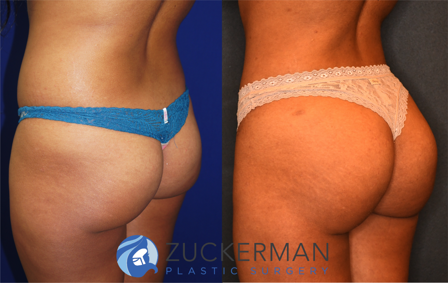 brazilian butt lift, bbl, buttock augmentation, 5, before and after, joshua zuckerman, posterior left oblique view