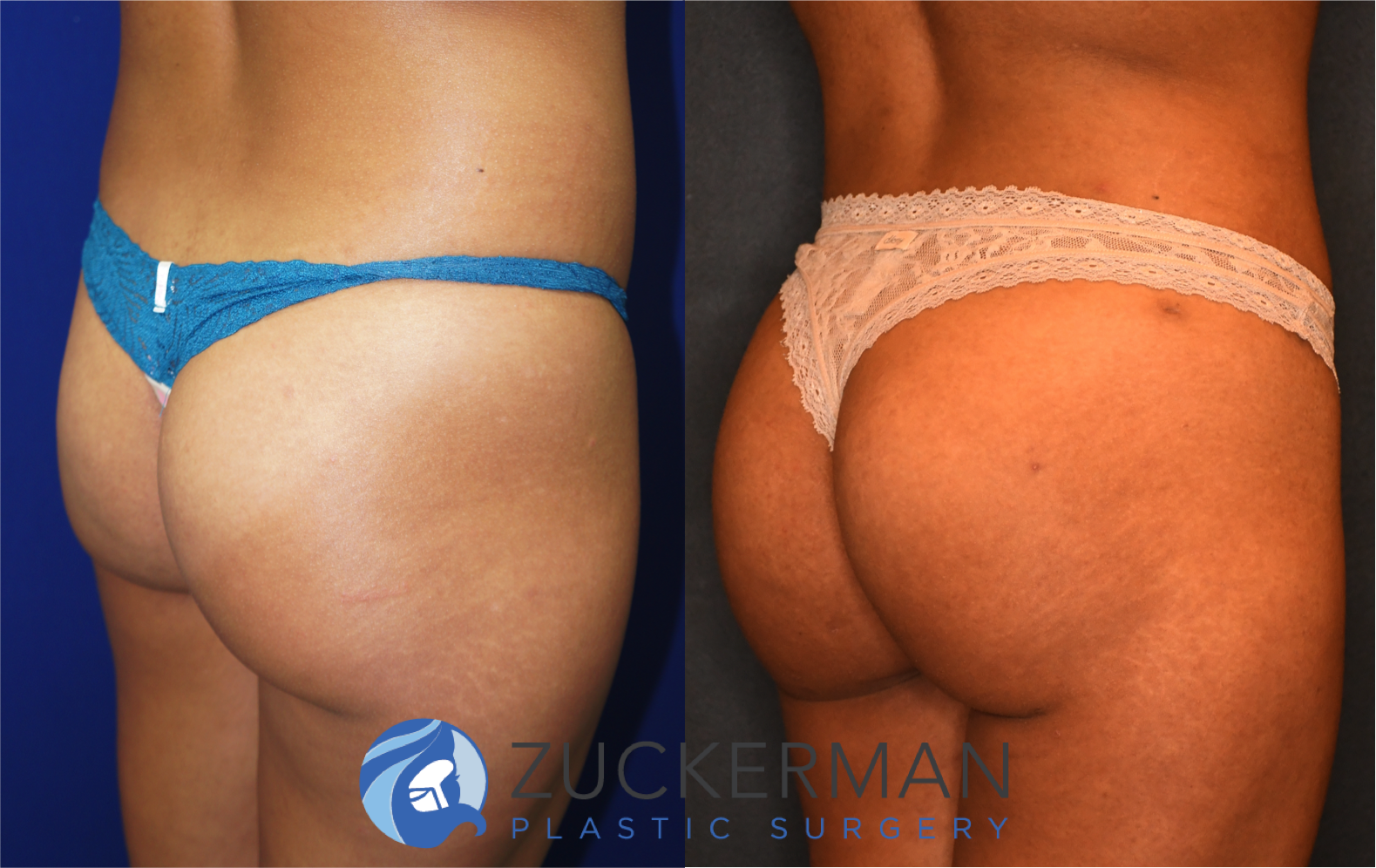 brazilian butt lift, bbl, buttock augmentation, 5, before and after, joshua zuckerman, posterior right oblique view