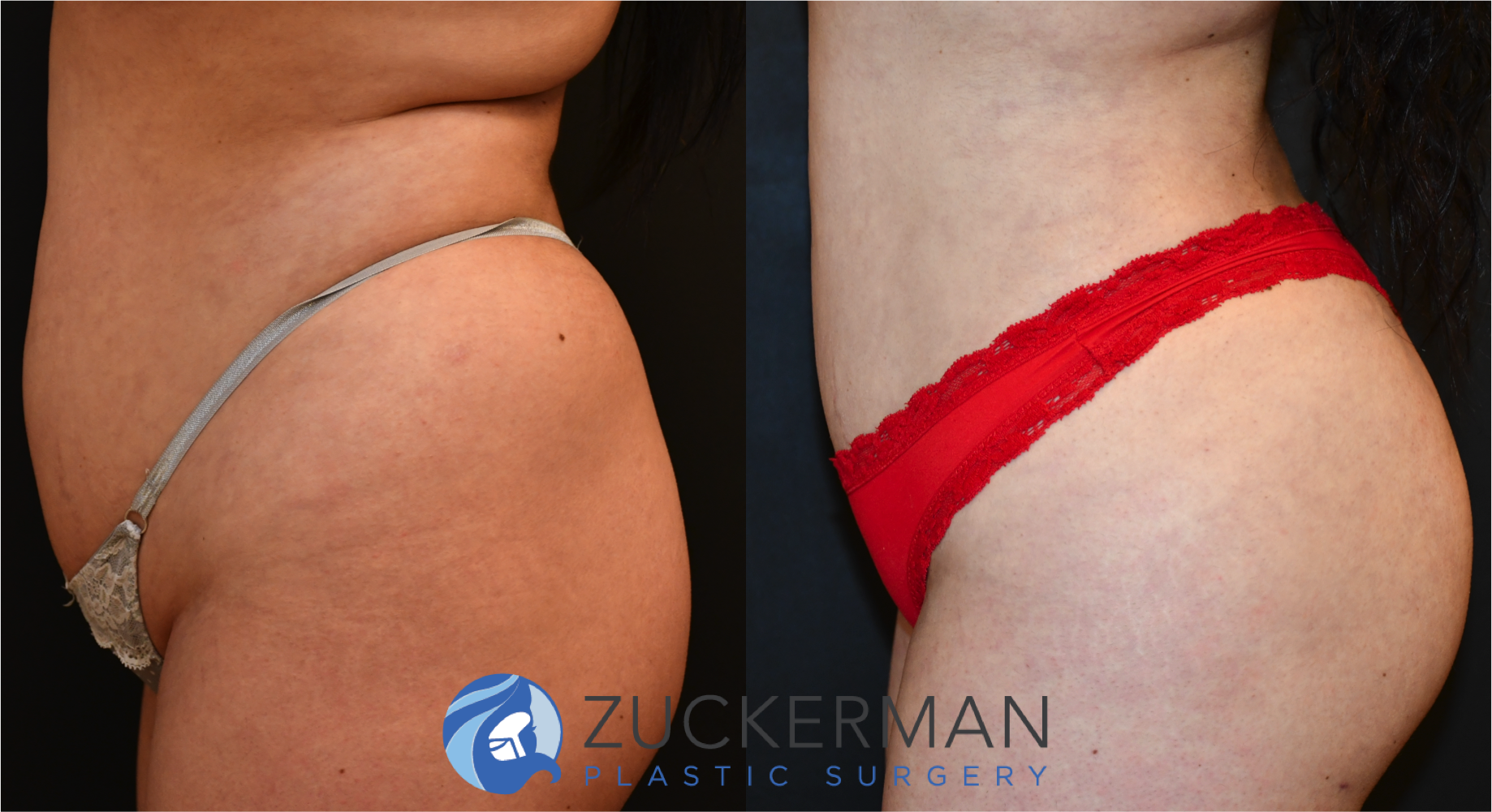 brazilian butt lift, bbl, buttock augmentation, 7, before and after, joshua zuckerman, left profile view