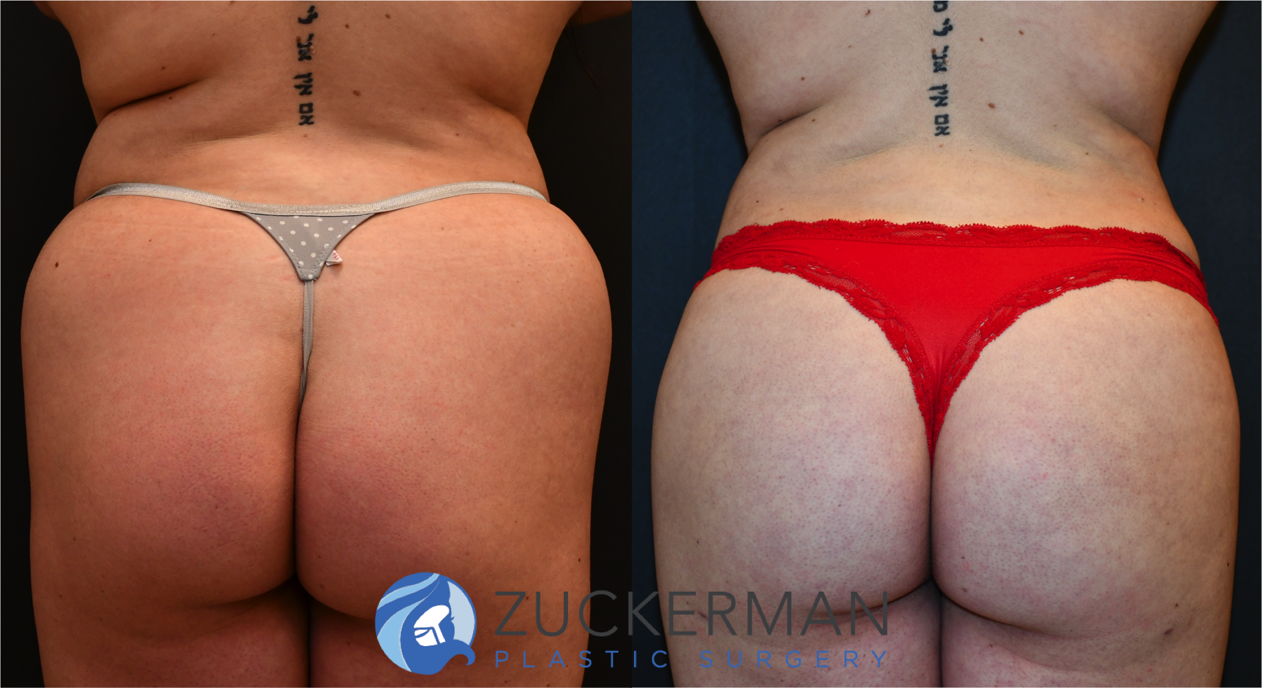 brazilian butt lift, bbl, buttock augmentation, 7, before and after, joshua zuckerman, posterior view