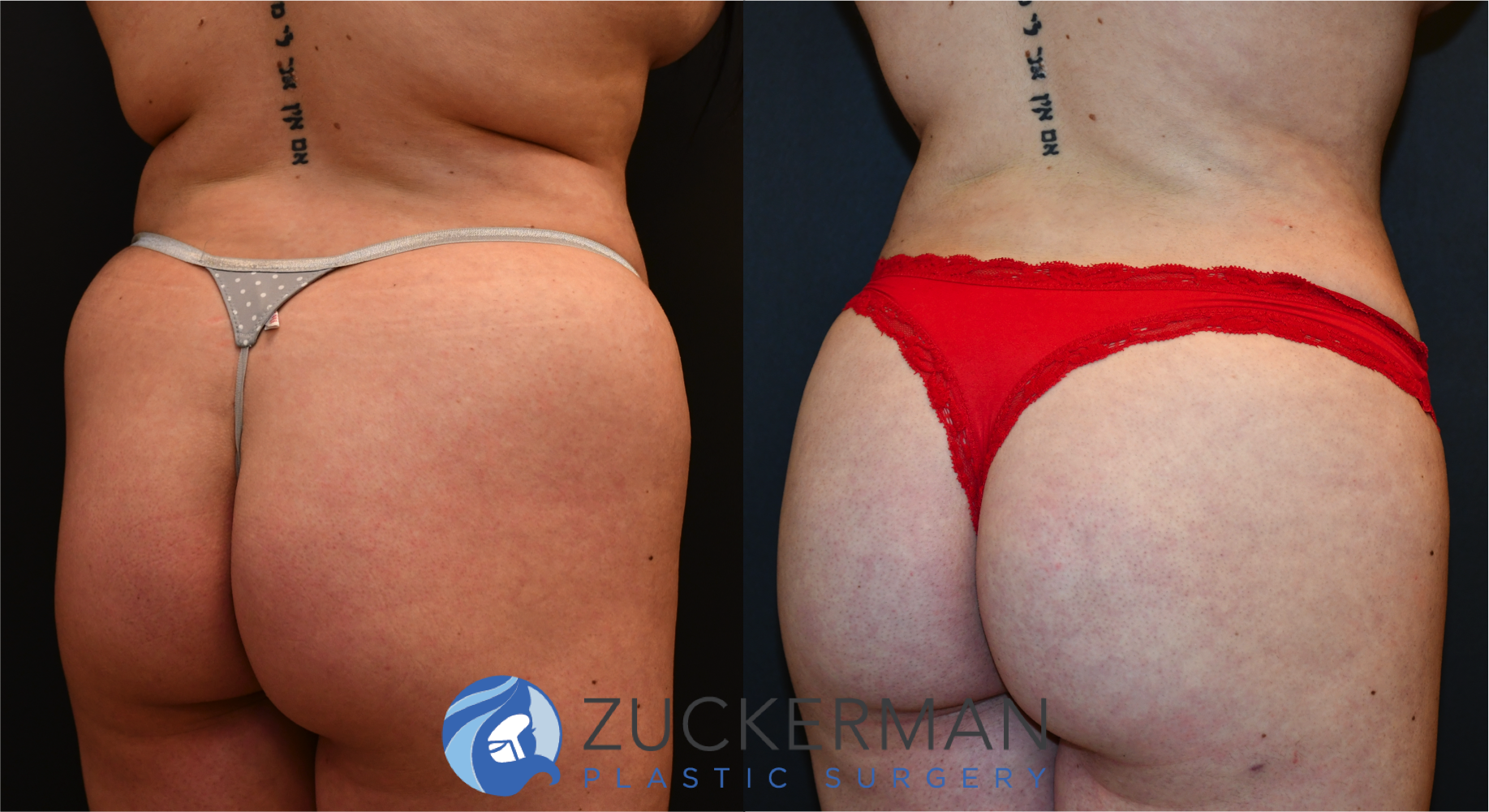 brazilian butt lift, bbl, buttock augmentation, 7, before and after, joshua zuckerman, right posterior oblique view
