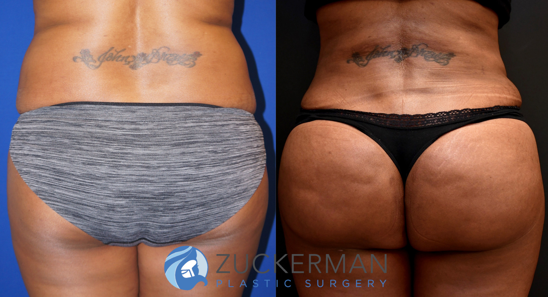 brazilian butt lift, bbl, buttock augmentation, 7, before and after, joshua zuckerman posterior view