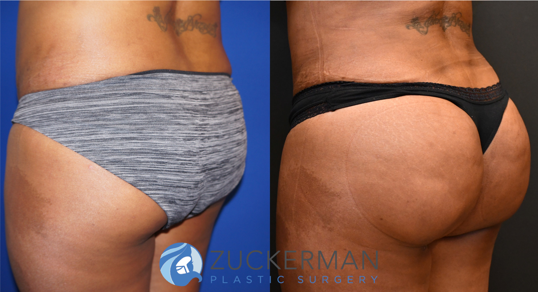brazilian butt lift, bbl, buttock augmentation, 7, before and after, joshua zuckerman posterior left oblique view