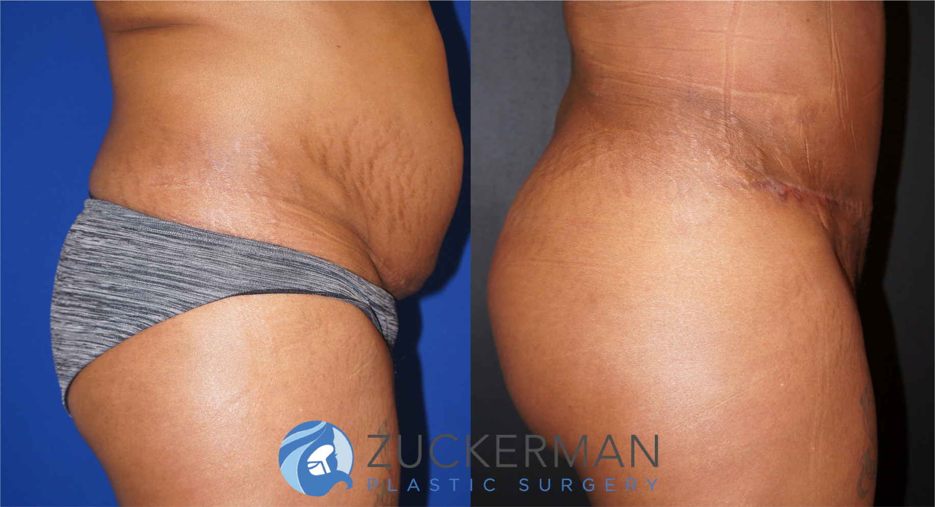 brazilian butt lift, bbl, buttock augmentation, 7, before and after, joshua zuckerman, right profile view