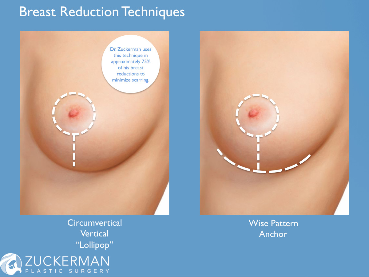 breast reduction surgery techniques, vertical, circumvertical, lollipop, wise pattern, anchor