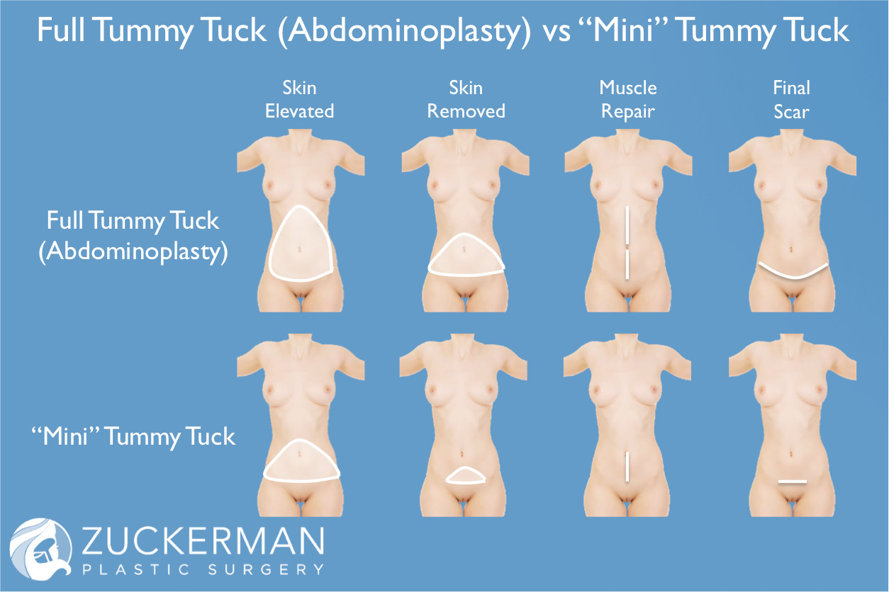 mini tummy tuck, abdominoplasty, incision, correction, scar