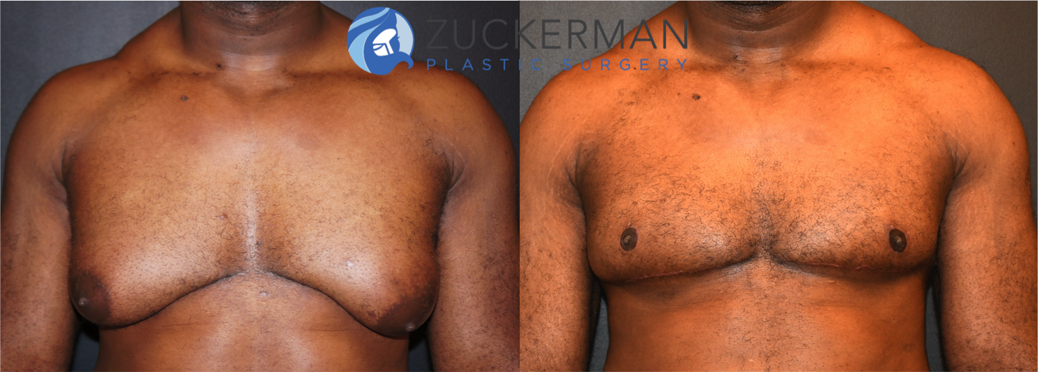 gynecomastia, male breast reduction, before and after, frontal view