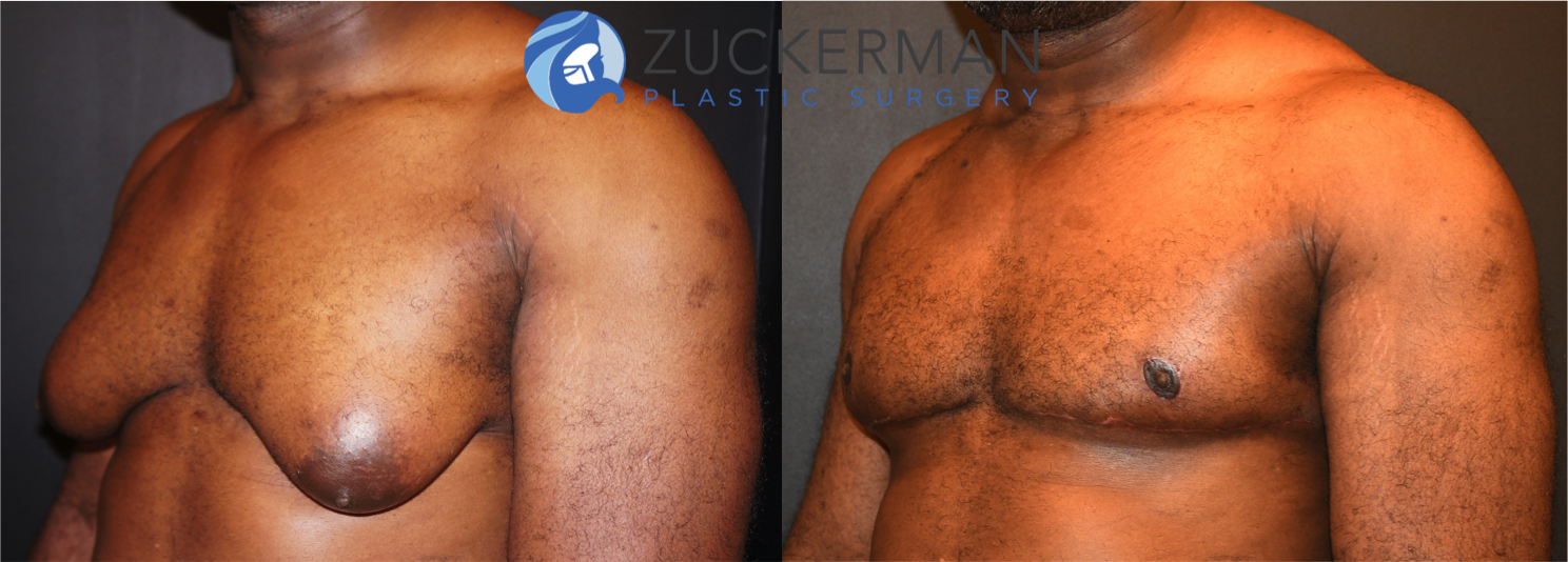 gynecomastia, male breast reduction, before and after, left oblique