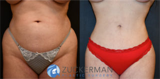 liposuction, abdomen, flanks, love handles, before and after, joshua zuckerman