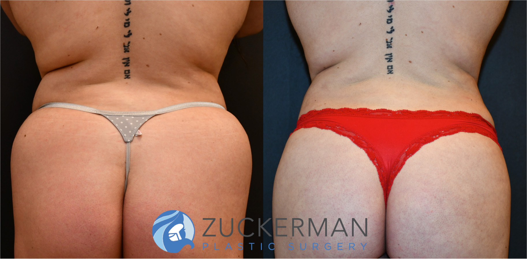 liposuction, back, abdomen, flanks, love handles, before and after, joshua zuckerman