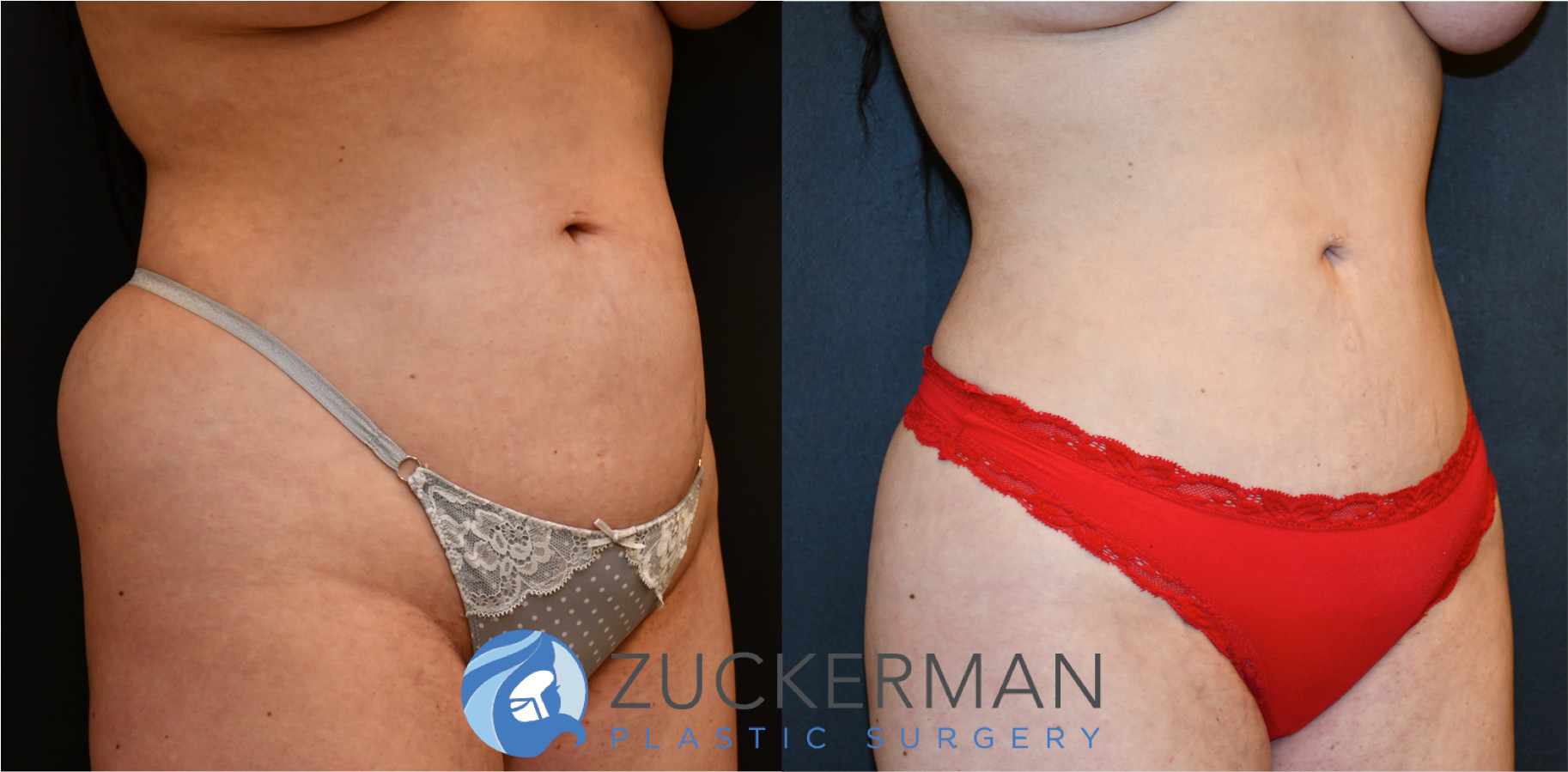 liposuction, abdomen, flanks, love handles, before and after, joshua zuckerman