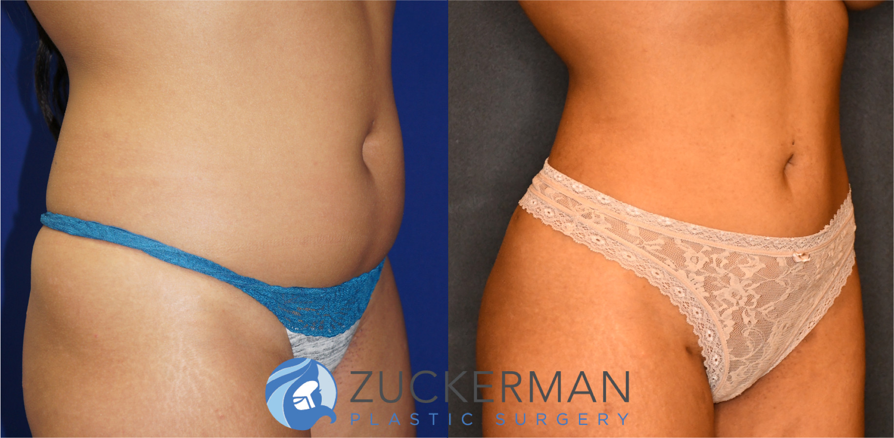 liposuction, back, abdomen, flanks, love handles, before and after, joshua zuckerman