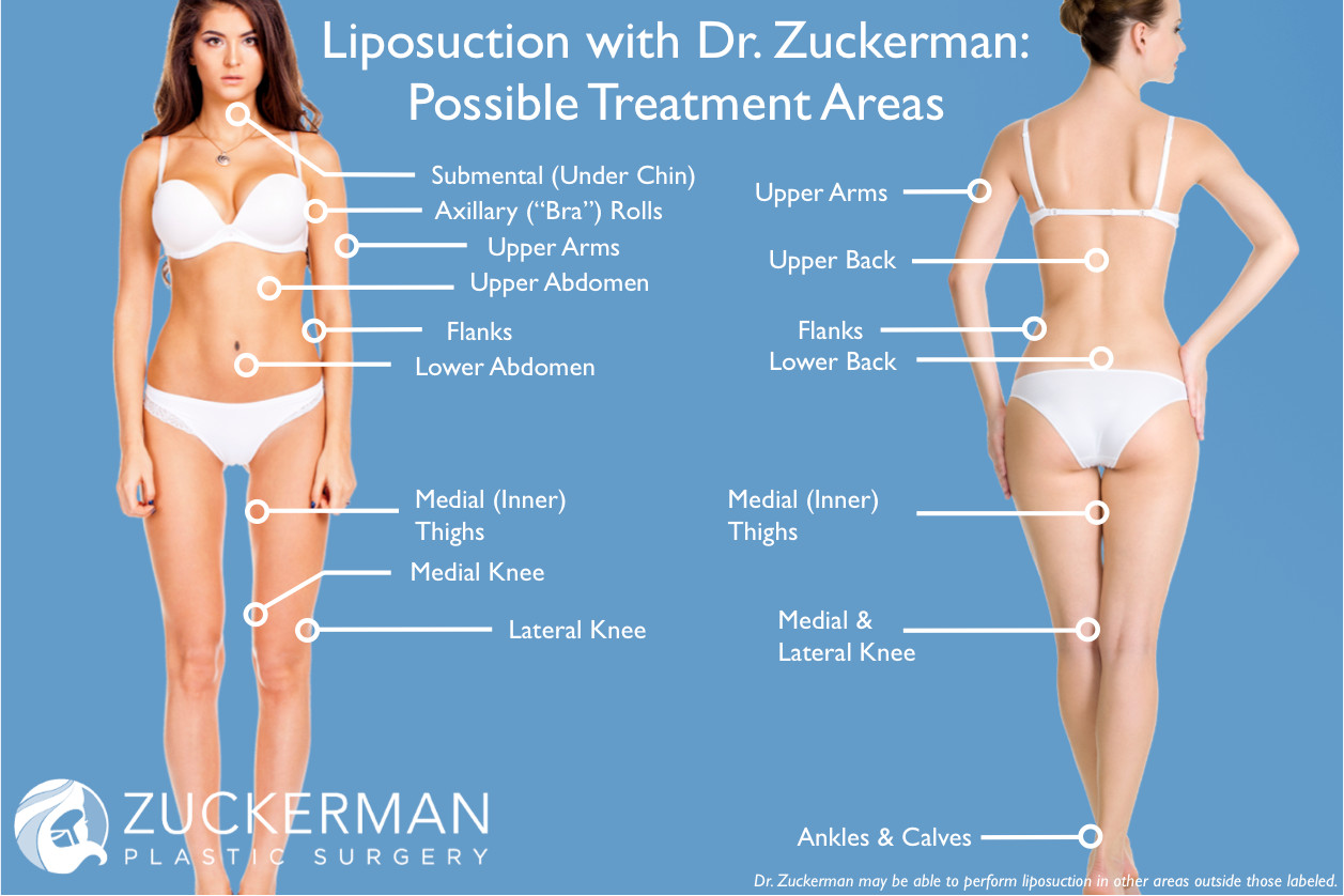 Liposuction, abdomen, back, arms, neck, knees, thighs, nyc