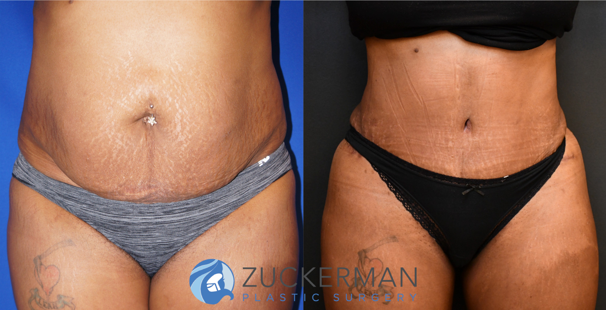 tummy tuck, abdominoplasty, 16, before and after, joshua zuckerman, frontal