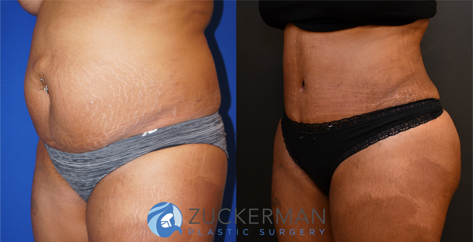 tummy tuck, abdominoplasty, 16, before and after, joshua zuckerman, left oblique
