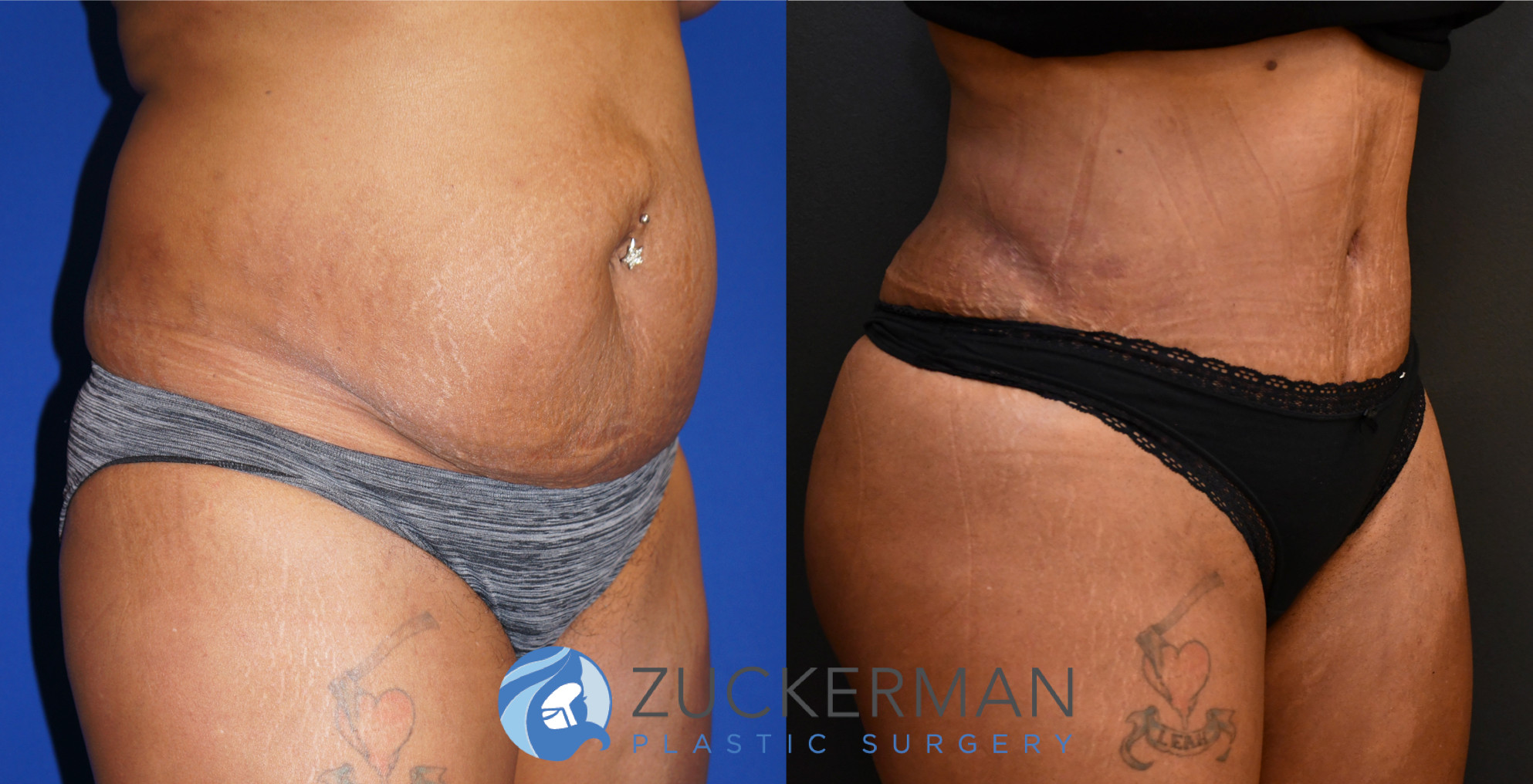 tummy tuck, abdominoplasty, 16, before and after, joshua zuckerman, right oblique