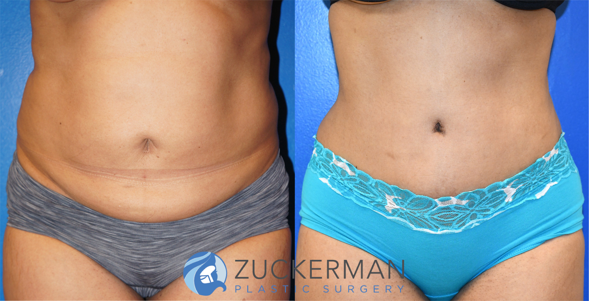 tummy tuck, abdominoplasty, 17, before and after, joshua zuckerman, frontal