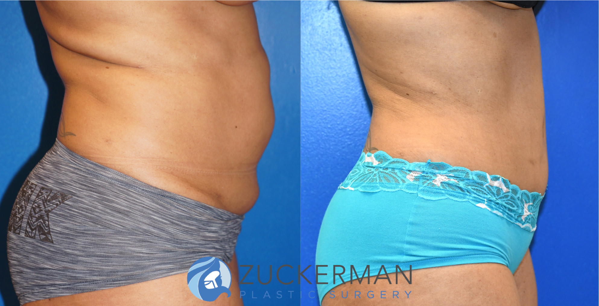 tummy tuck, abdominoplasty, 17, before and after, joshua zuckerman, right profile