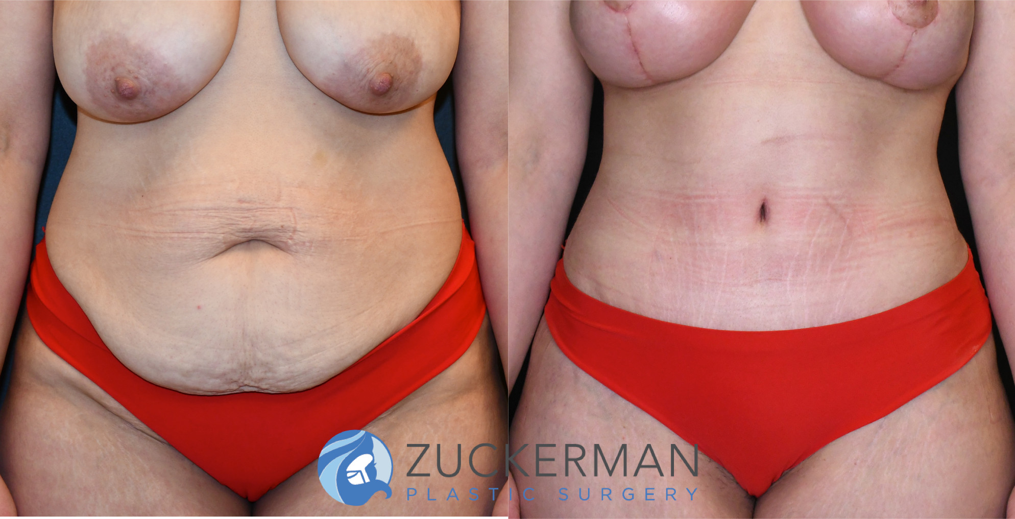 tummy tuck, abdominoplasty, before and after, liposuction, joshua zuckerman, frontal, 19