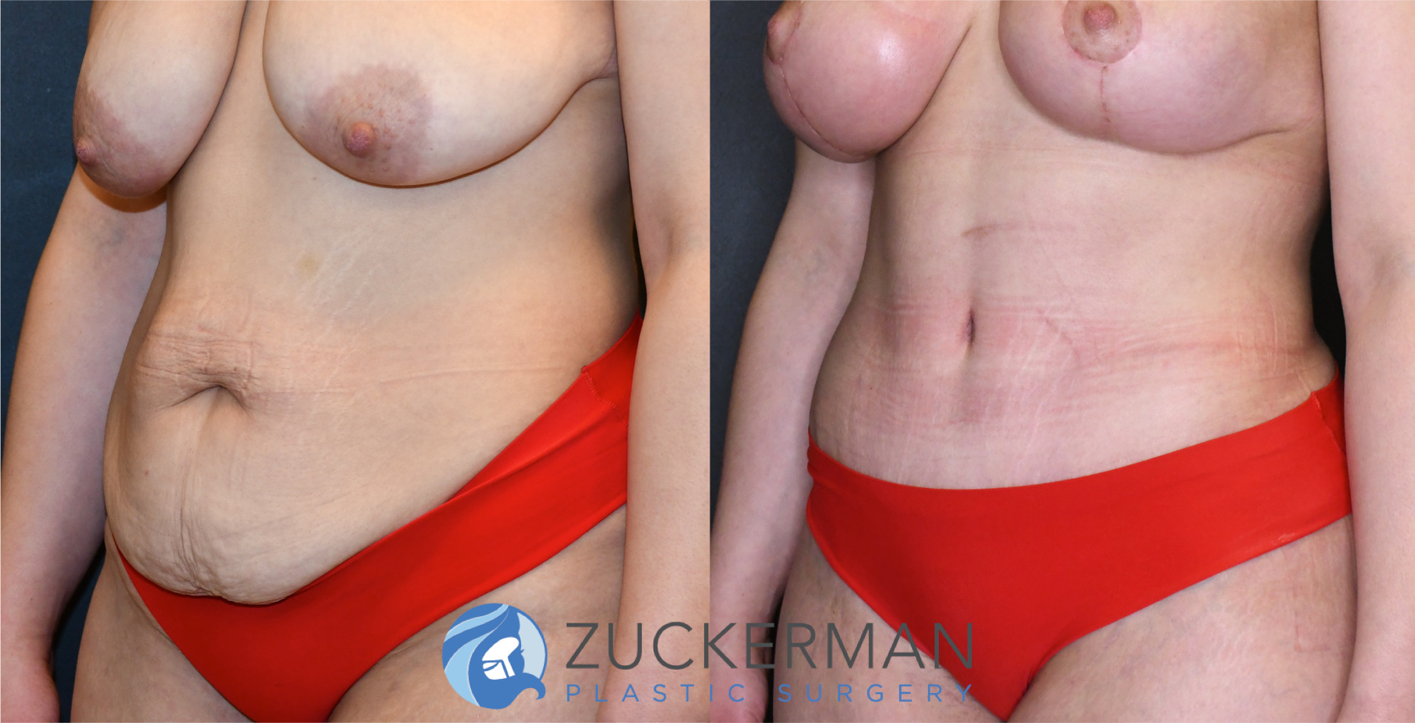 tummy tuck, abdominoplasty, before and after, liposuction, joshua zuckerman, left oblique, 19