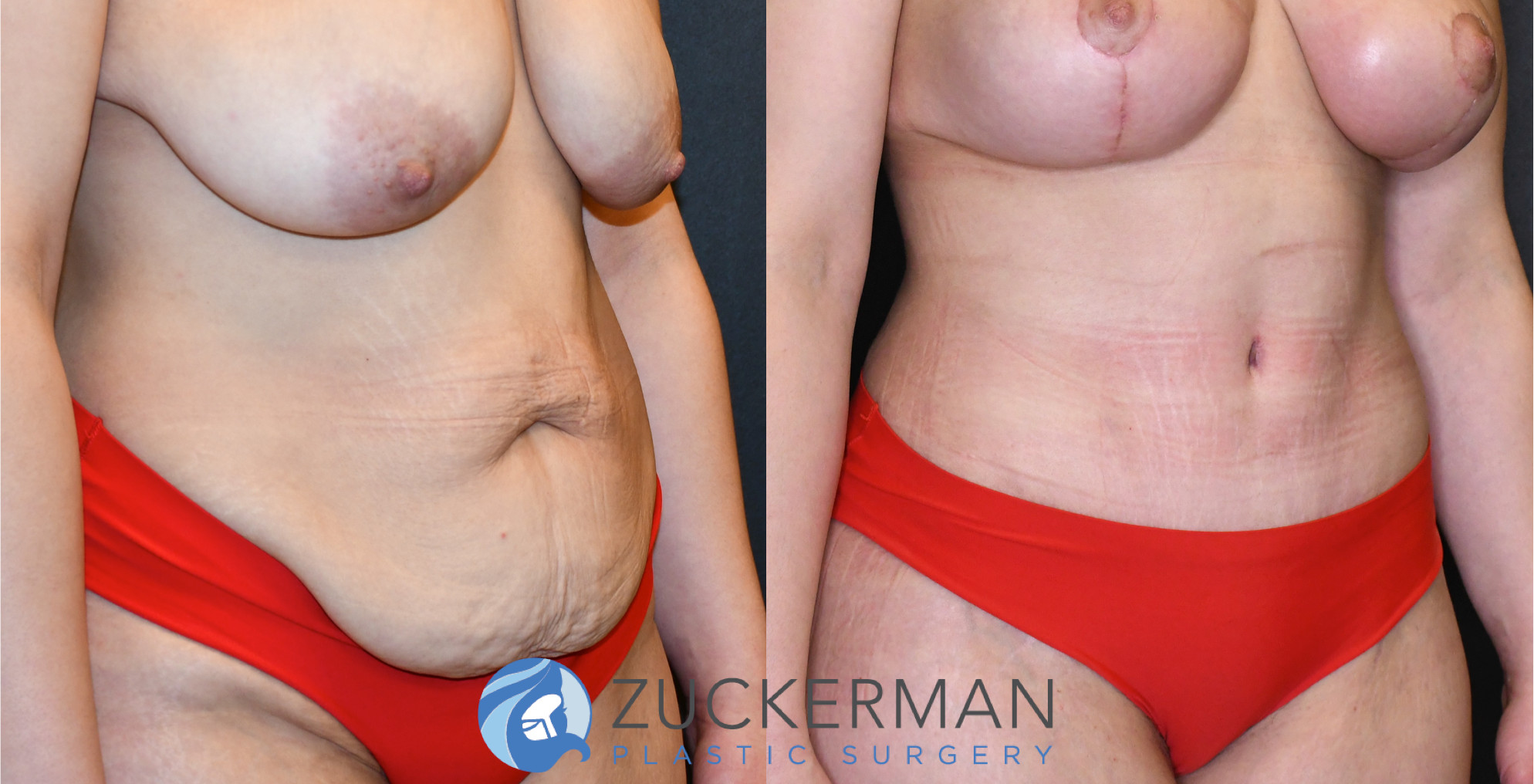 tummy tuck, abdominoplasty, before and after, liposuction, joshua zuckerman, right oblique, 19
