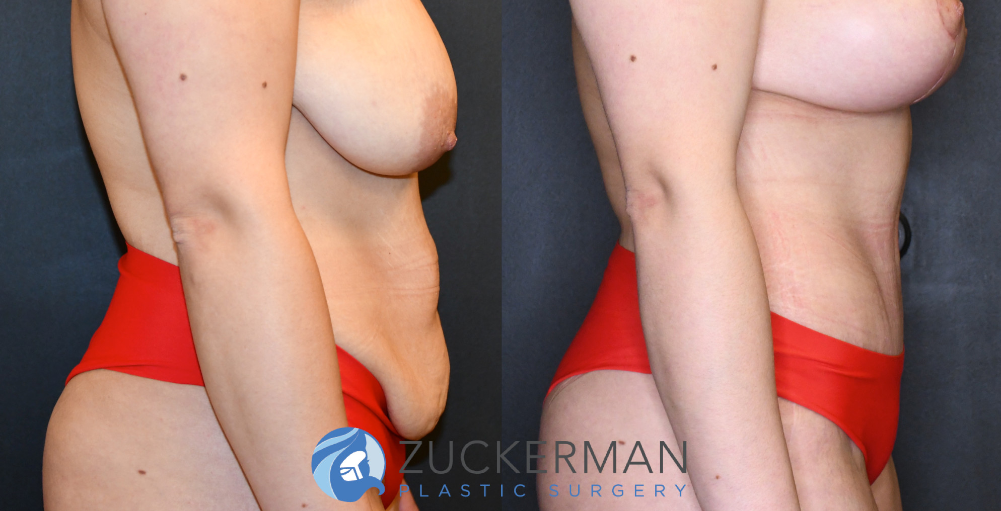 tummy tuck, abdominoplasty, before and after, liposuction, joshua zuckerman, right profile, 19