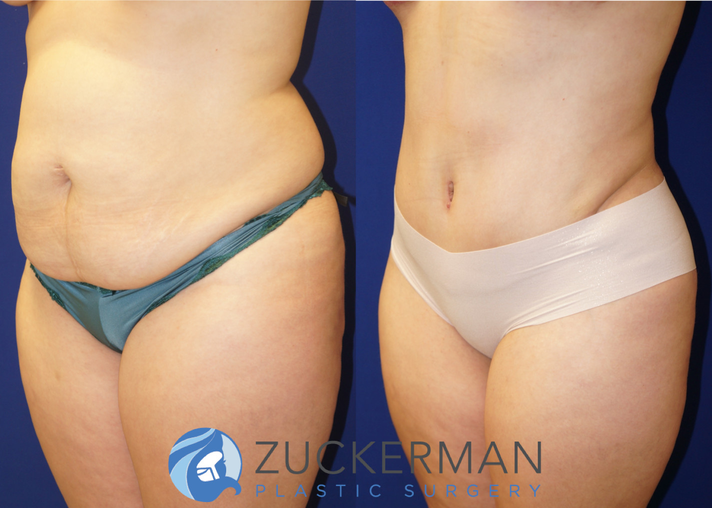 tummy tuck, abdominoplasty, 9, before and after, joshua zuckerman, left oblique
