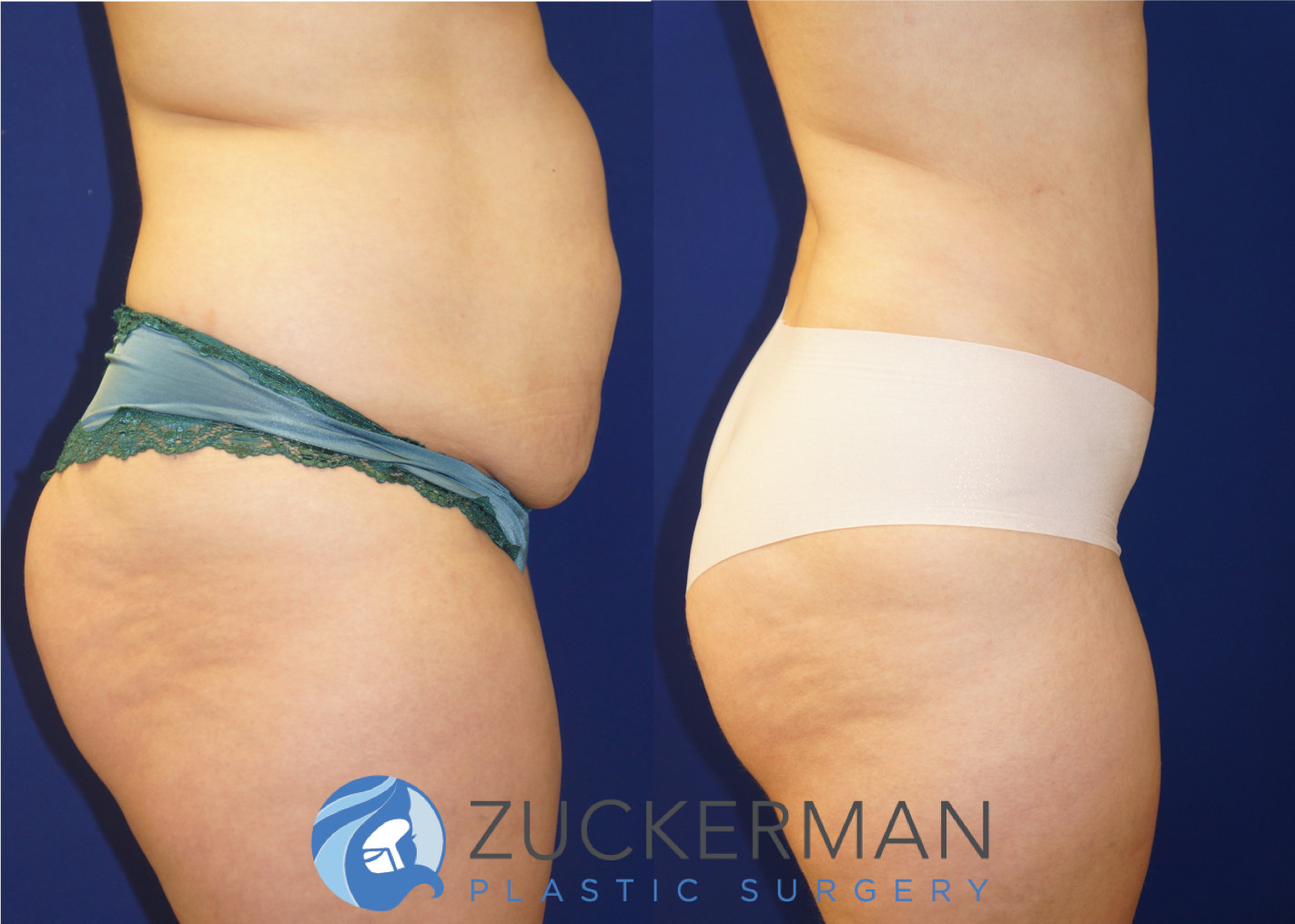tummy tuck, abdominoplasty, 9, before and after, joshua zuckerman, right profile