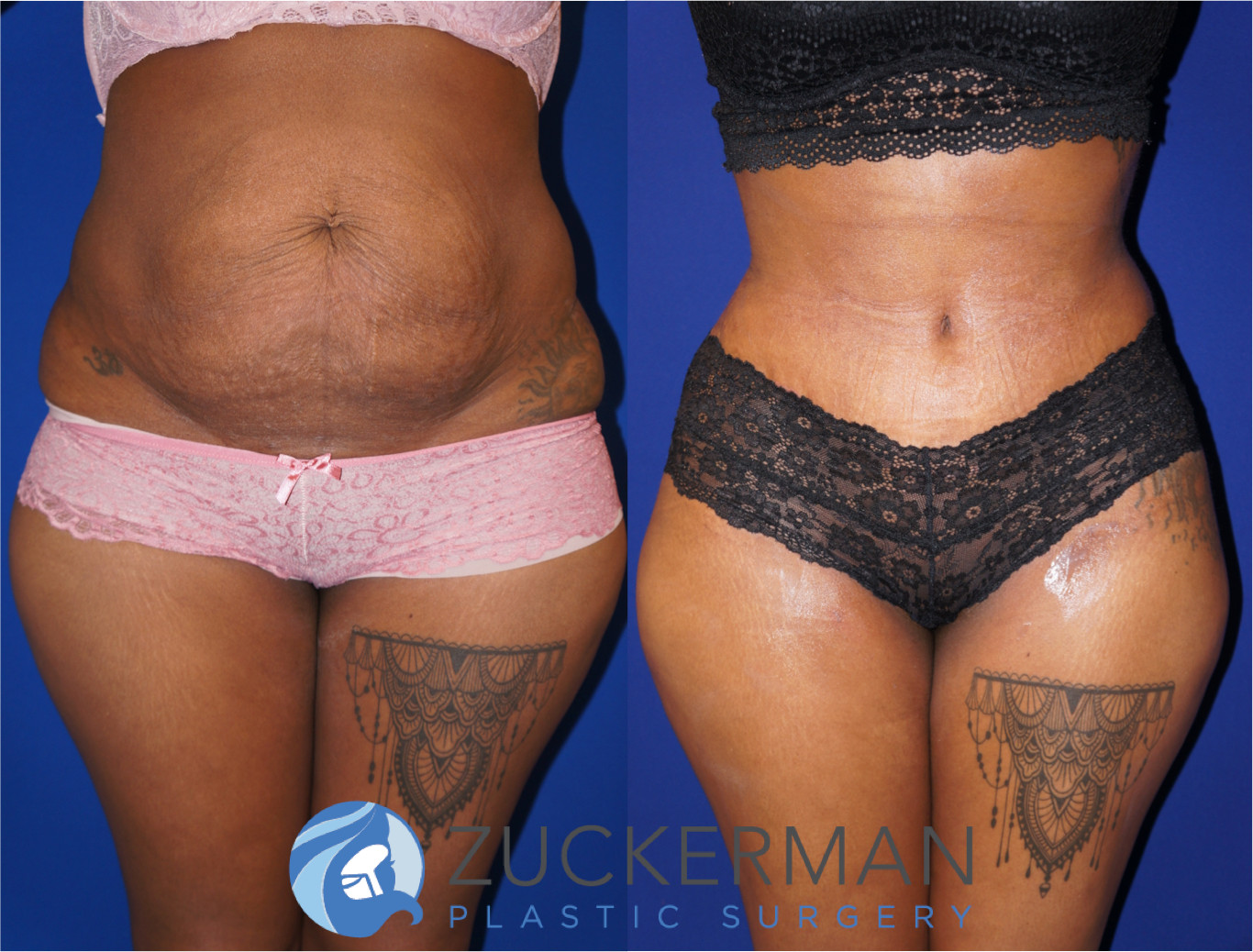 tummy tuck, abdominoplasty, before and after, liposuction, abdomen, flanks, love handles, joshua zuckerman