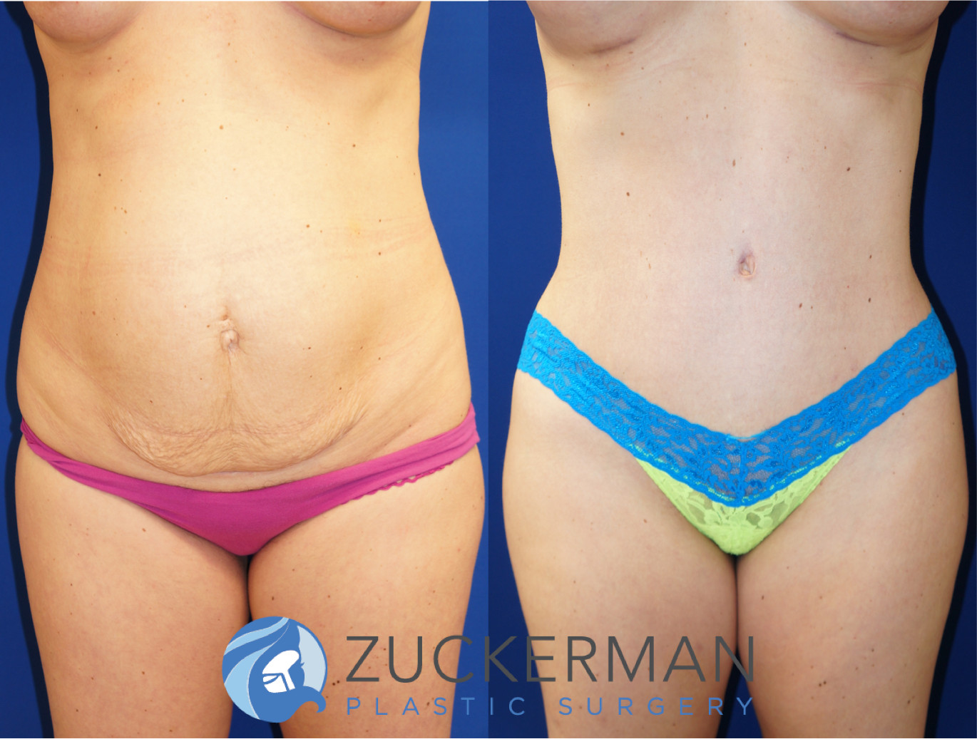 tummy tuck, abdominoplasty, before and after, joshua zuckerman