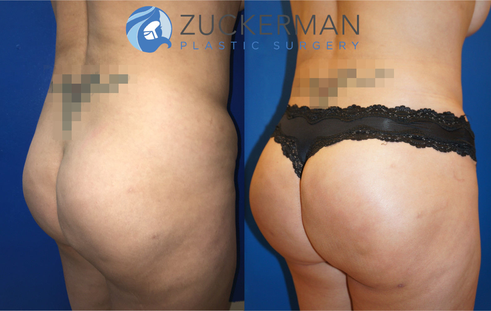brazilian butt lift, buttock augmentation, bbl, joshua zuckerman, 9, posterior right oblique