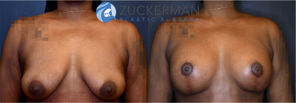 breast augmentation, 7, joshua zuckerman, combined mastopexy, frontal