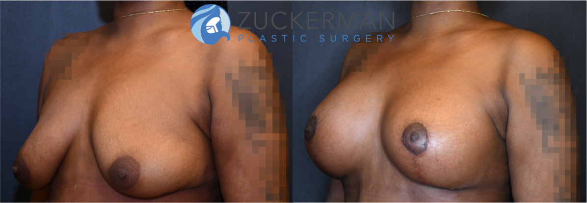 breast augmentation, 7, joshua zuckerman, combined mastopexy, right oblique