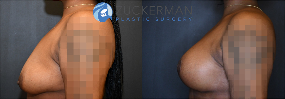 breast augmentation, 7, joshua zuckerman, combined mastopexy, left profile