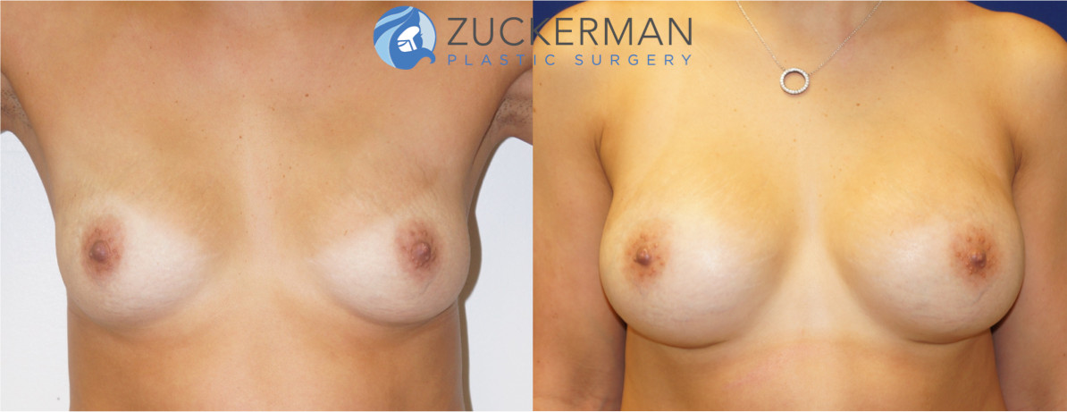 breast augmentation, round silicone breast implants, submuscular implant placement, breast asymmetry