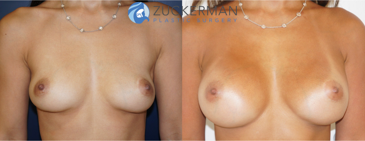 breast augmentation, round silicone breast implants, submuscular implant placement