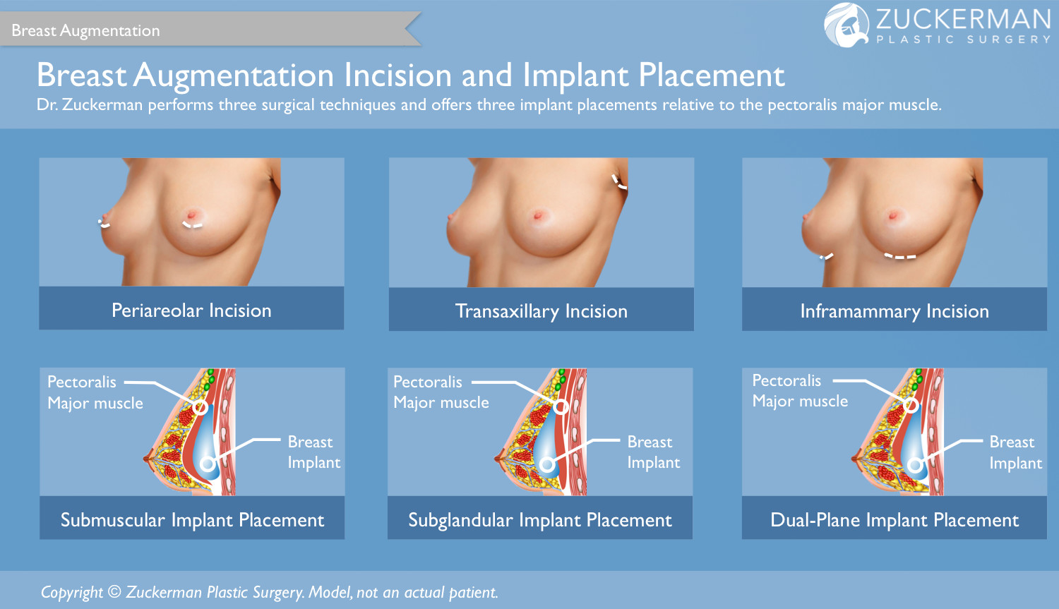 breast augmentation, incisions, implant placement, periareolar incision, transaxillary incision, inframammary incision, submuscular, subglandular, dual plane