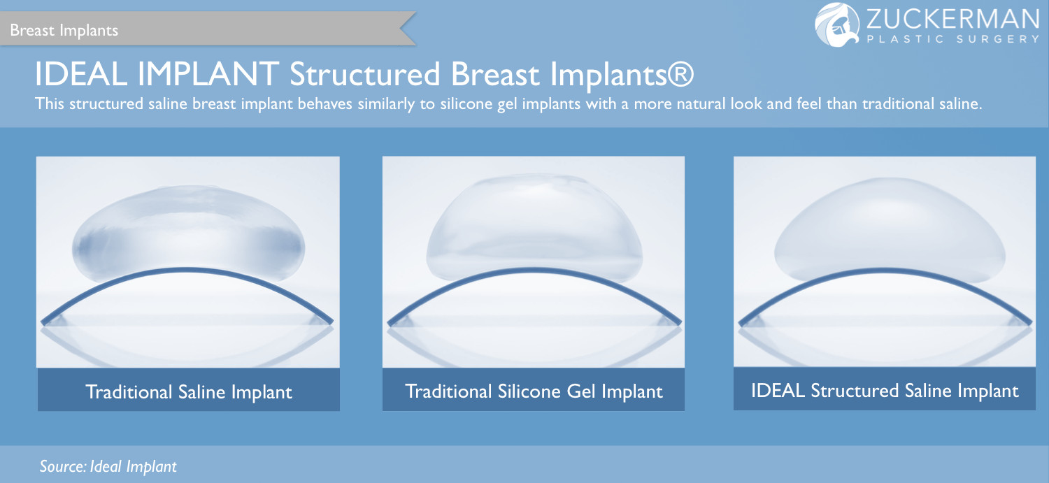 breast implants, ideal implants, structured saline